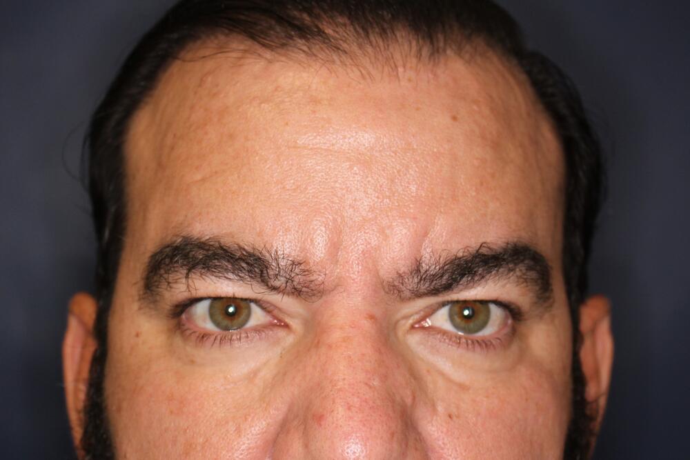 Brow Forehead Lift Before & After Image