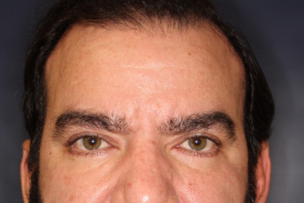 Brow Forehead Lift Before & After Image