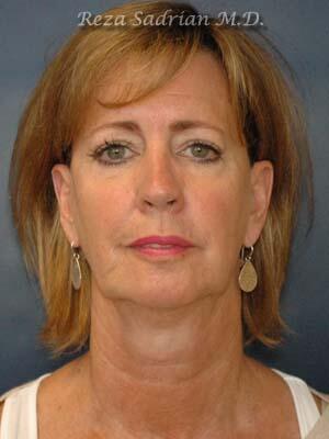 Face & Neck Lift Before & After Image