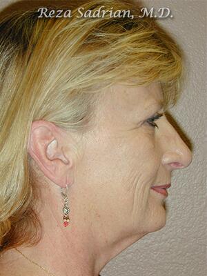 Face & Neck Lift Before & After Image