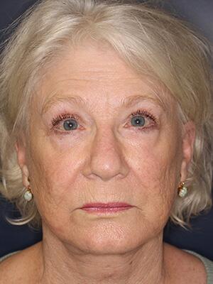 Face & Neck Lift Before & After Image