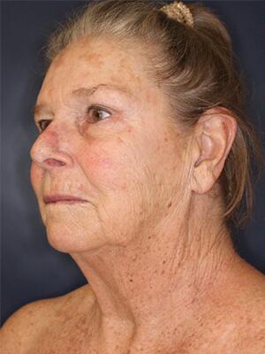 Face & Neck Lift Before & After Image