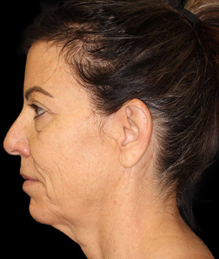 Face & Neck Lift Before & After Image