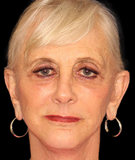 Face & Neck Lift Before & After Image