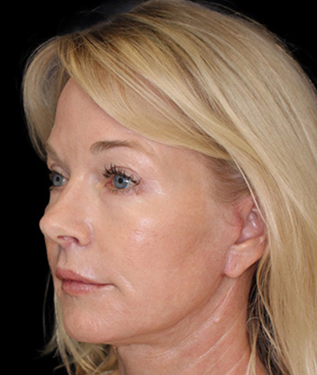 Face & Neck Lift Before & After Image