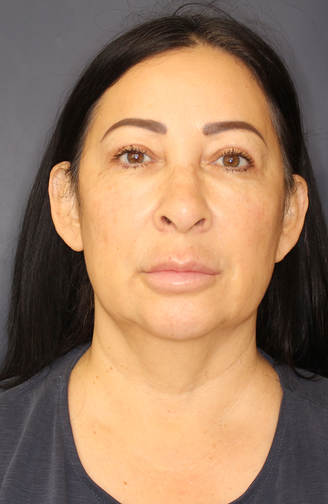 Face & Neck Lift Before & After Image