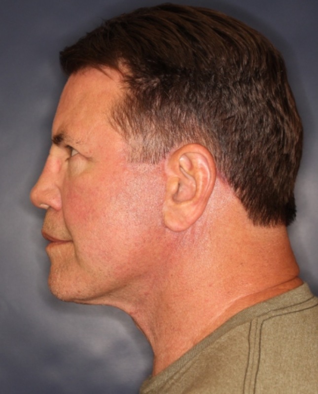Face & Neck Lift Before & After Image