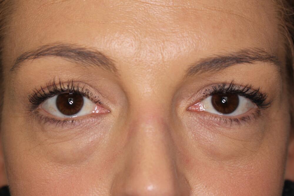 Fat Grafting Before & After Image