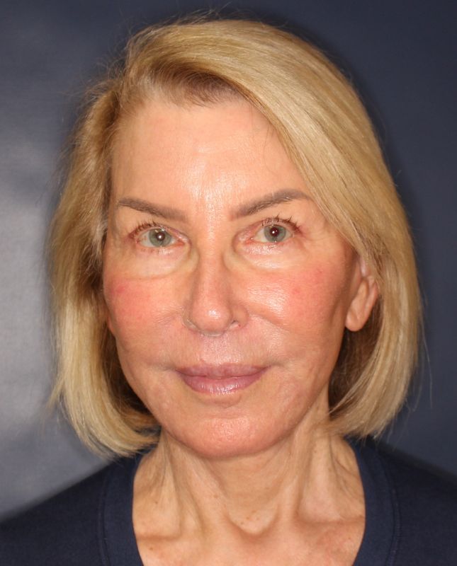 Lip Lift Before & After Image
