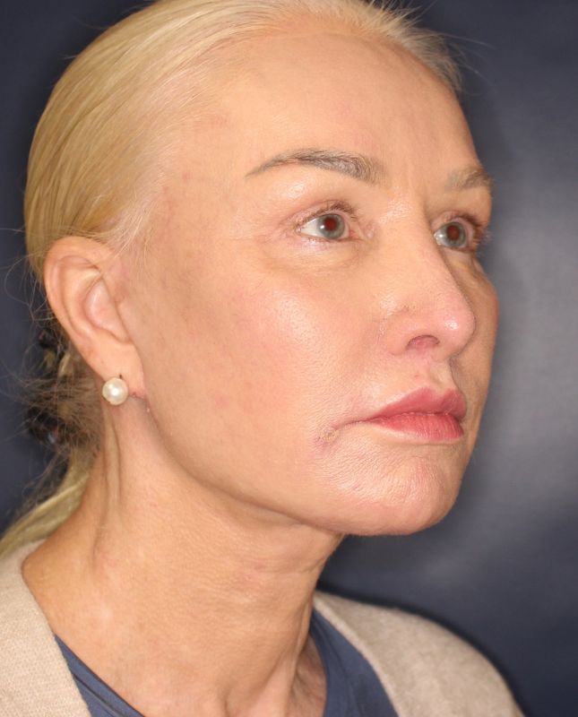 Lip Lift Before & After Image
