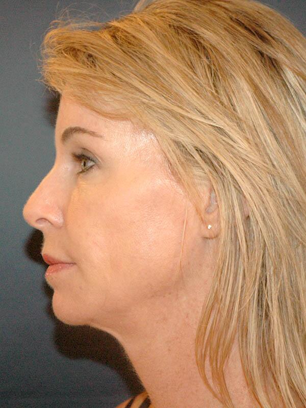 Nose Reshaping Before & After Image
