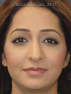 Nose Reshaping Before & After Image