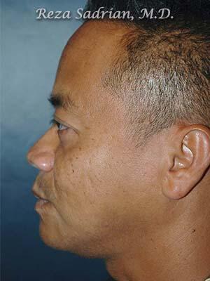 Nose Reshaping Before & After Image