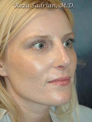 Nose Reshaping Before & After Image