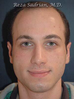 Nose Reshaping Before & After Image