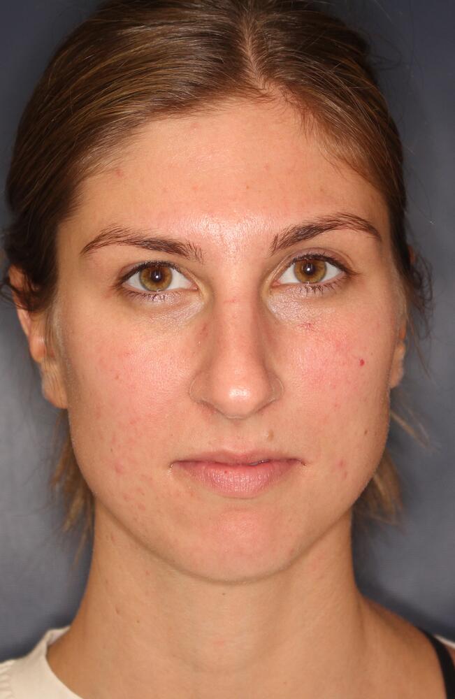 Nose Reshaping Before & After Image