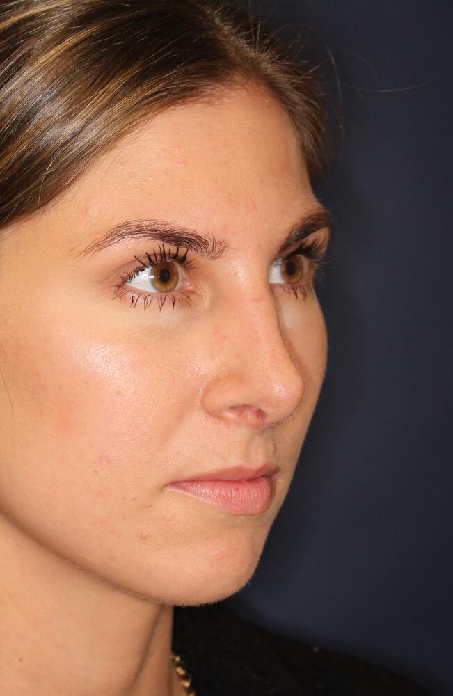 Nose Reshaping Before & After Image