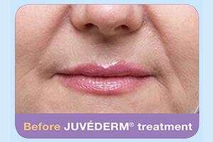Dermal Fillers Before & After Image