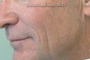 Fractional Resurfacing Before & After Image