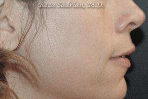 IPL Before & After Image