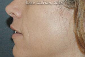 IPL Before & After Image