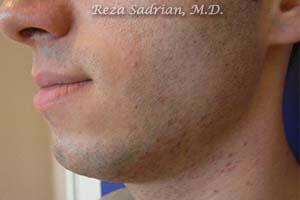 Laser Genesis Before & After Image