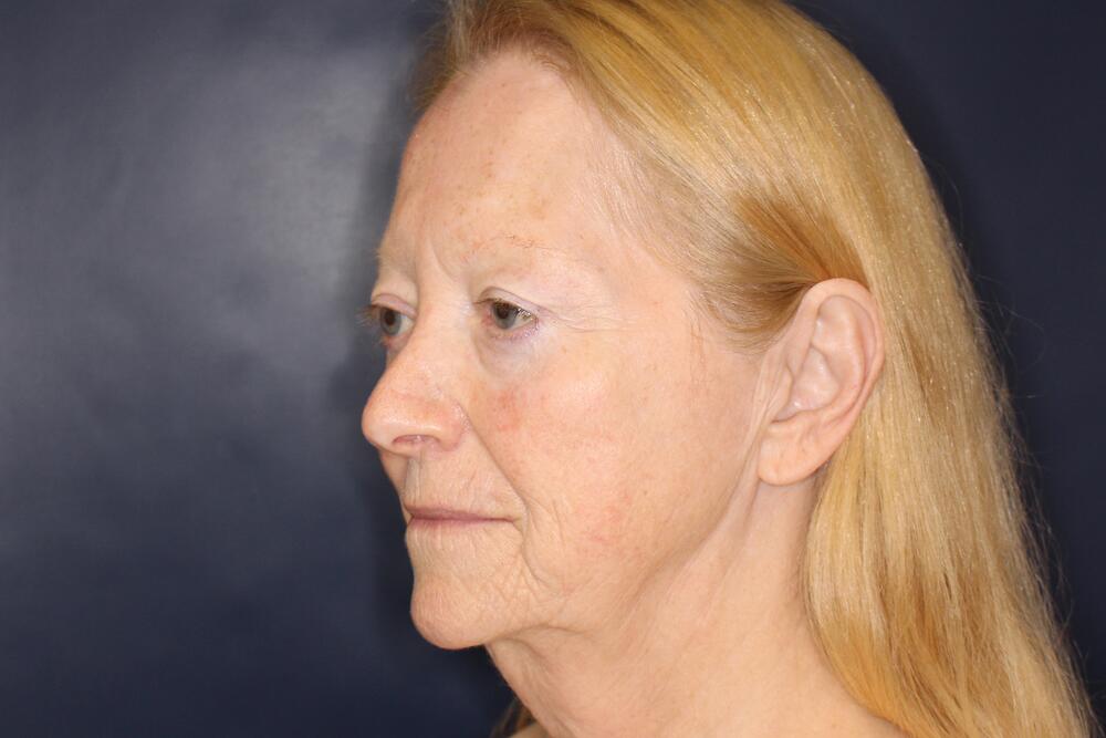Laser Resurfacing Before & After Image