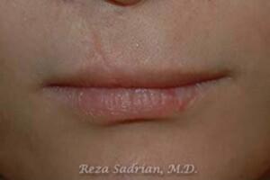 Laser Resurfacing Before & After Image