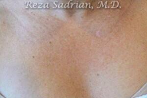 Laser Resurfacing Before & After Image