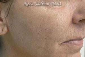 Laser Resurfacing Before & After Image