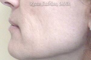 Laser Resurfacing Before & After Image
