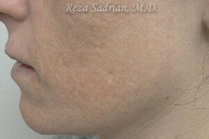 Laser Resurfacing Before & After Image